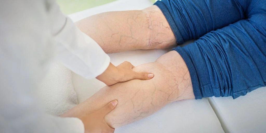 Лечение варикоза вен нижних конечностей в Орле	